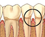 Perfect Smile periodontium with periodontitis